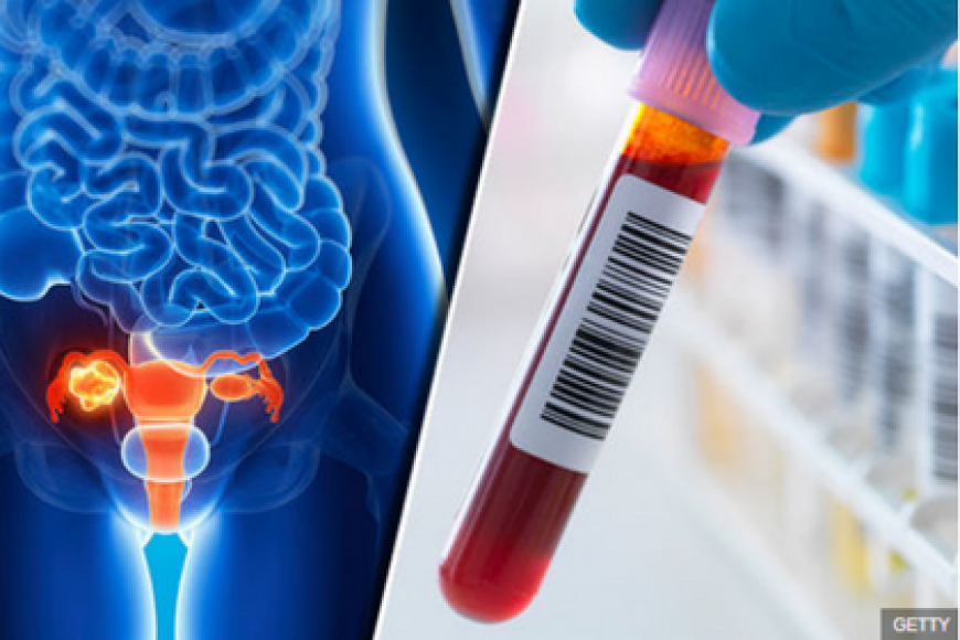 NEW BLOOD TEST DEVELOPED TO DIAGNOSE OVARIAN CANCER